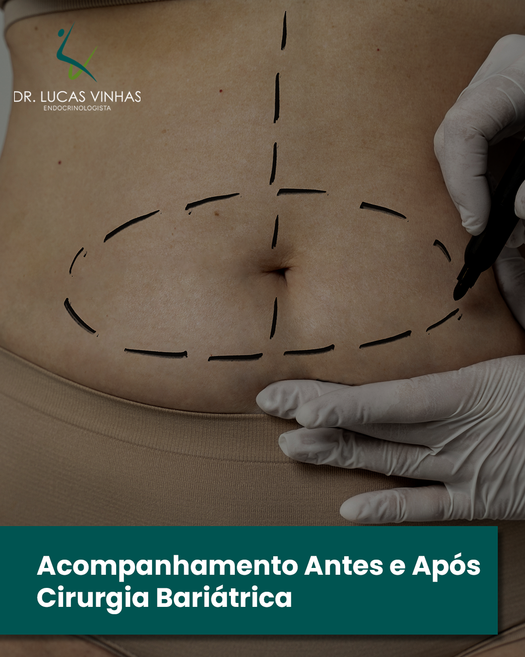 Acompanhamento antes e após cirurgia bariátrica