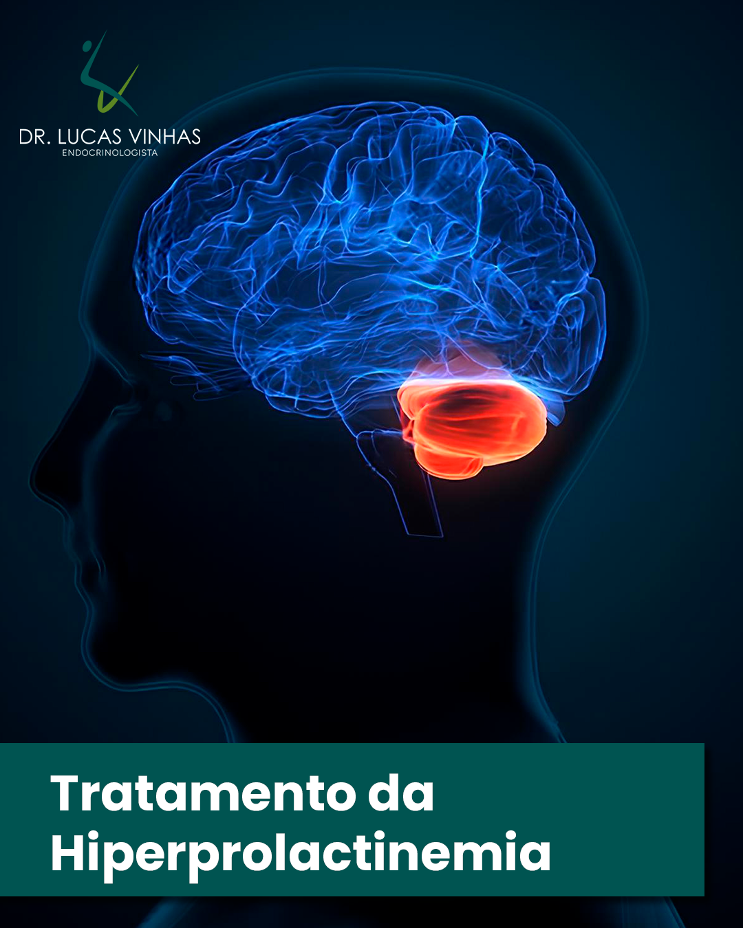 Tratamento da hiperprolactinemia 2